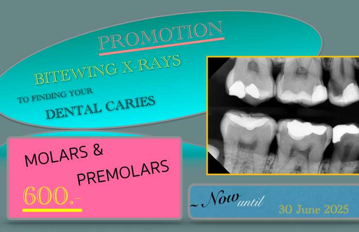 DIGITAL BITEWING X-RAYS