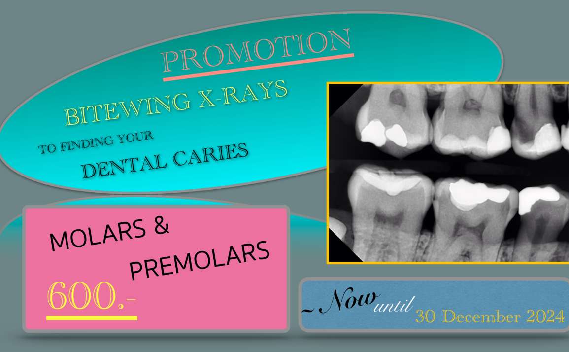 DIGITAL BITEWING X-RAYS