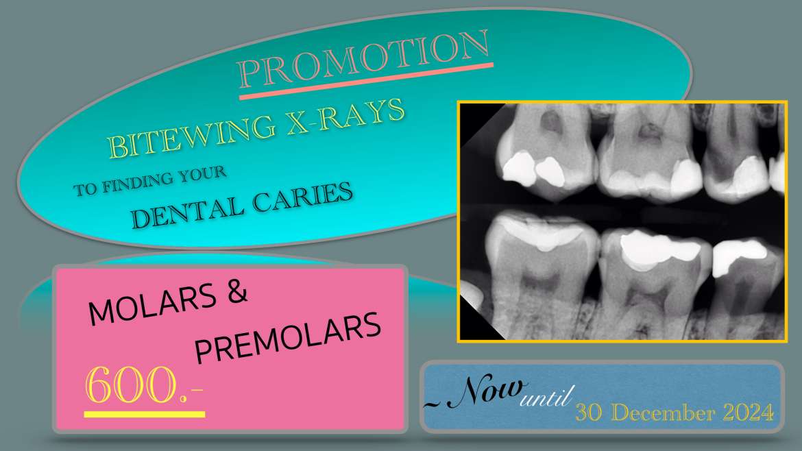 DIGITAL BITEWING X-RAYS