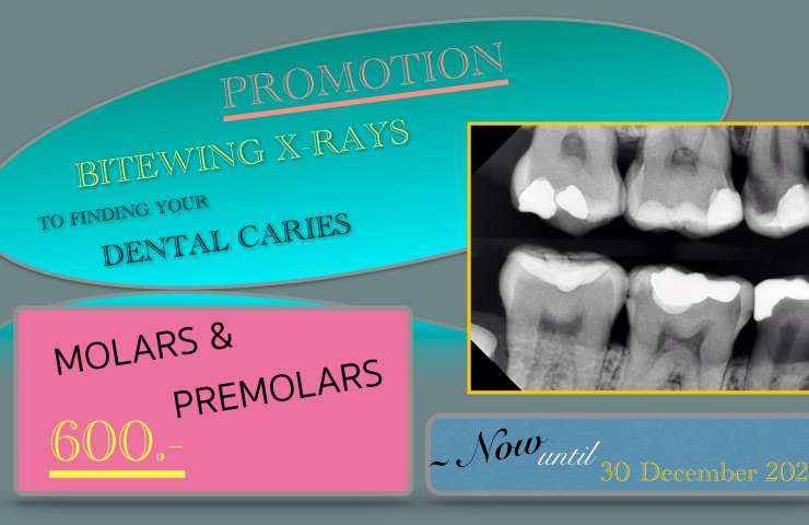 DIGITAL BITEWING X-RAYS