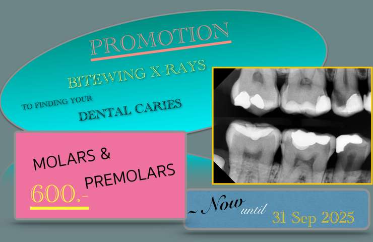 DIGITAL BITEWING X-RAYS